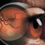 Some Interesting  Facts About Diabetic Retinopathy