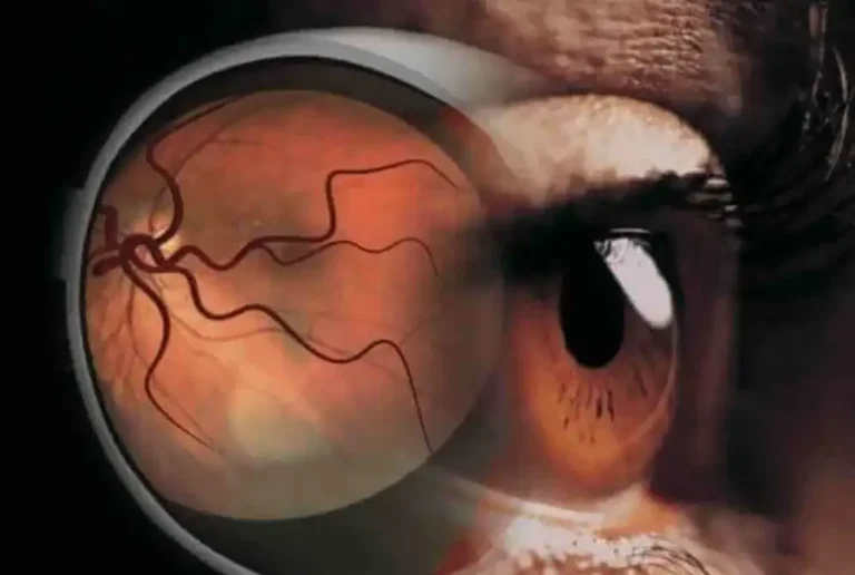 Some-Interesting-Facts-about-Diabetic-Retinopathy